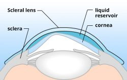 Lente Escleral Saúde Ocular
