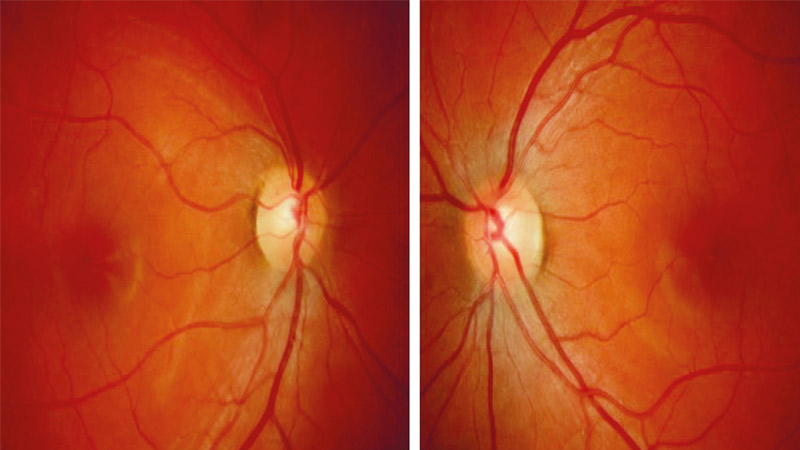 glaucoma