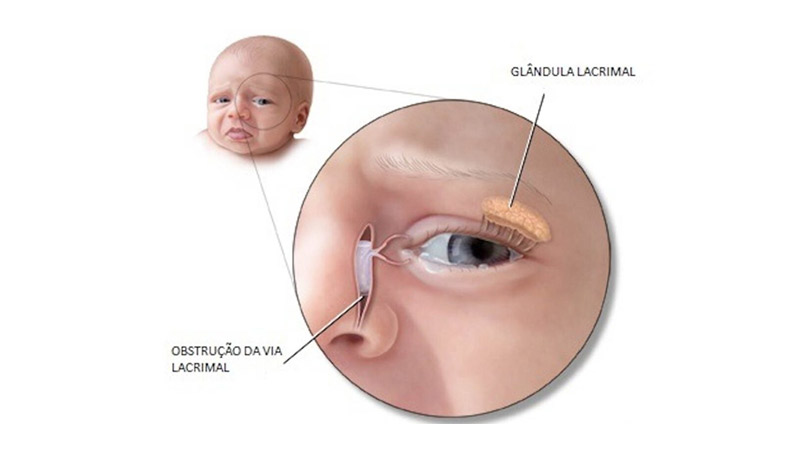 Obstrução da via lacrimal