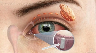 Plug de Silicone para olho seco dr. renato garcia oftalmo