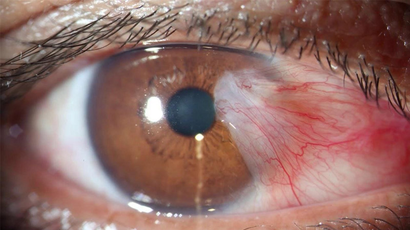 Pterígeo Saúde Ocular