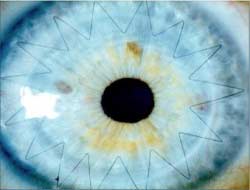Suturas do transplante de Córnea Saúde Ocular