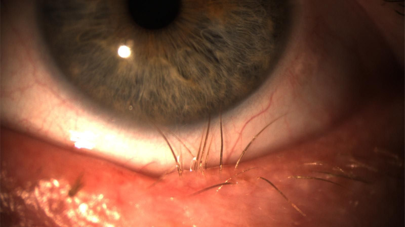 Triquíase: cílios invertidos tocando o olho