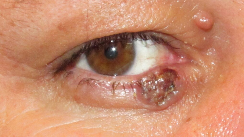 Tumores palpebrais Saúde Ocular