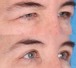 Blefaroplastia Saúde Ocular