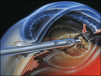 Cirurgia catarata