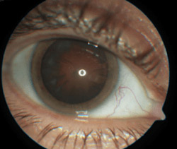 cirurgia de catarata