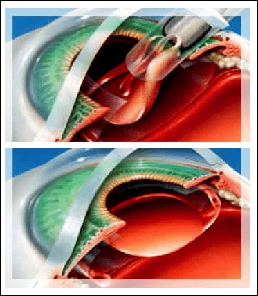 lentes intraoculares dr. Renato Garcia Oftalmologista