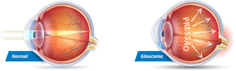 Pressão intraocular comprimindo nervo óptico