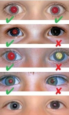 Sinais de alerta na avaliação oftalmológica das crianças